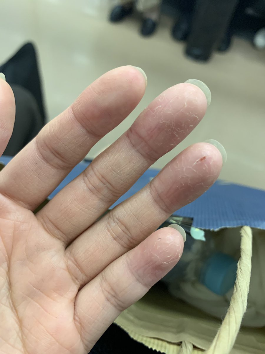 りん 肌のカサカサが市販薬で治りにくい 指先から掌 爪の下あたりもガサガサしたり 膿 んでしまったり ひび割れているといった人は皮膚科に早めに行くのをお勧めします 膿んだところをかいてかゆくて眠れなくなる時もありました 酷くなる前に皮膚科に