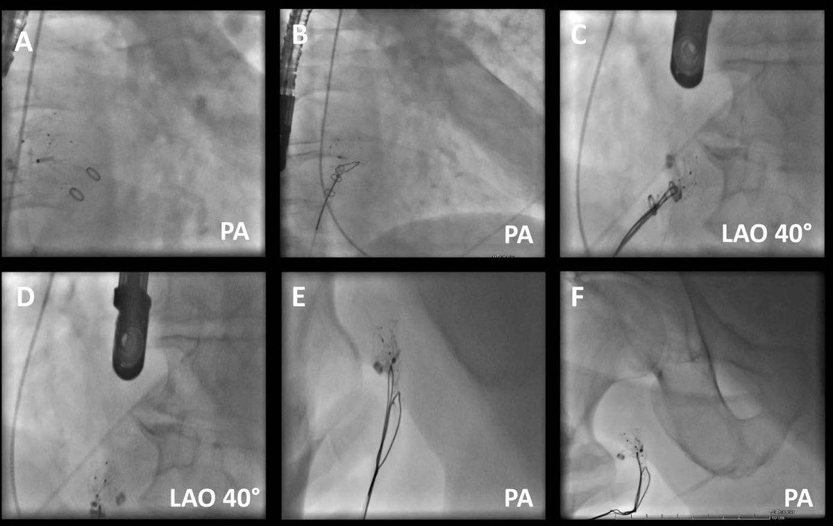 EuroInterventio's tweet photo. "Retrieval of embolised LAAC devices" by Shinwan Kany et al. #EAPCI https://t.co/JAbiftUv2C https://t.co/GDm4dTAeHy