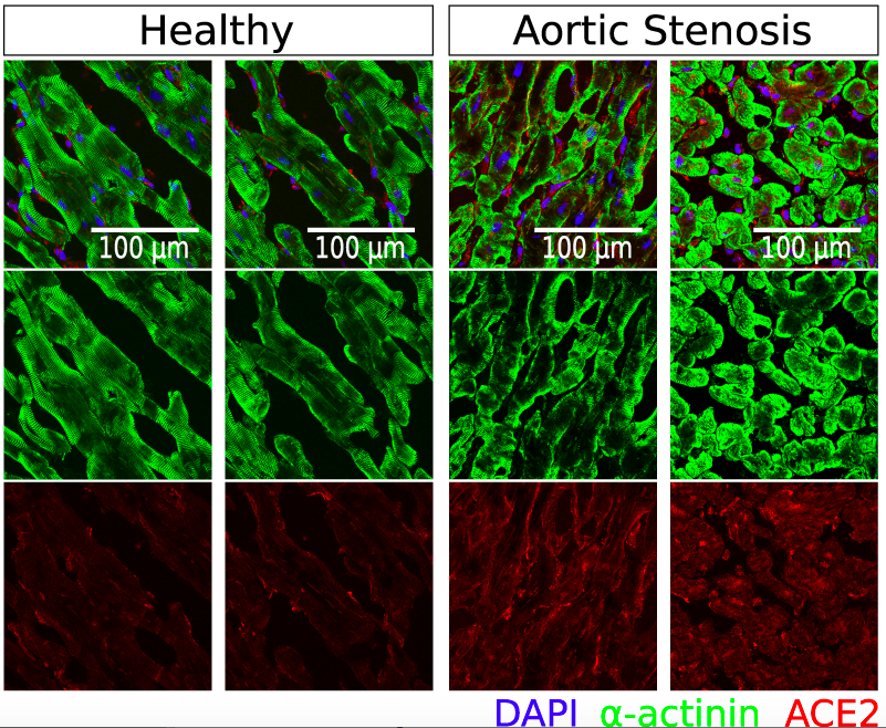 CPI_ExStra's tweet photo. New paper from Nicin et. al. in EHJ on the putative #Sarscov2 receptor ACE2 in human hearts. Find the paper here https://t.co/21LTp2PFbr
@ESC_Journals #COVID19 #Dimmeler_Lab #Dimmelerlab https://t.co/UzsNVjjQcI