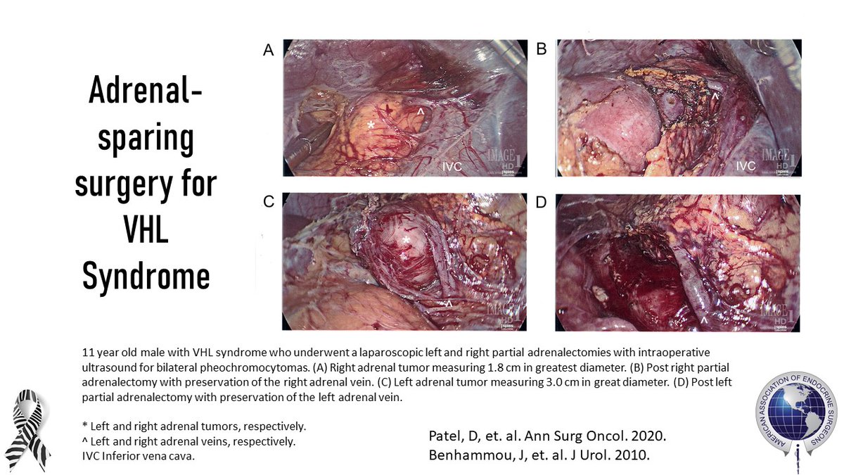 American Association of Endocrine Surgeons (@theaaes) on Twitter photo Partial adrenalectomies for VHL syndrome result in a rate of about 11% for steroid dependency, 11% chance of local recurrence, and 11% of contralateral recurrence over 9.25 years (median f/u) #AADAM2020 @NADF_President <a href="/TheAACE/">AACE</a> <a href="/TheEndoSociety/">Endocrine Society</a> <a href="/PheoPara/">Pheo Para Alliance</a> <a href="/VHLAlliance/">VHL Alliance</a> Partial adrenalectomies for VHL syndrome result in a rate of about 11% for steroid dependency, 11% chance of local recurrence, and 11% of contralateral recurrence over 9.25 years (median f/u) #AADAM2020 @NADF_President <a href="/TheAACE/">AACE</a> <a href="/TheEndoSociety/">Endocrine Society</a> <a href="/PheoPara/">Pheo Para Alliance</a> <a href="/VHLAlliance/">VHL Alliance</a>