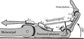 Orthopaedics MSc UCL (@orthomscucl) on Twitter photo The flexor pulley system: 
1) A2 and A4 prevent bowstringing -> most biomechanically important
  
2) A1, A3, and A5 overlie the MP, PIP and DIP joints respectively -> originate from palmar plate
  
3) A1 pulley most commonly involved in trigger finger 
#orthotwitter #MScUCL The flexor pulley system: 
1) A2 and A4 prevent bowstringing -> most biomechanically important
  
2) A1, A3, and A5 overlie the MP, PIP and DIP joints respectively -> originate from palmar plate
  
3) A1 pulley most commonly involved in trigger finger 
#orthotwitter #MScUCL