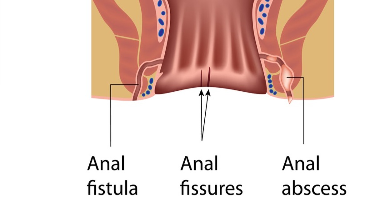 Anal Abscess, Fissure Fistula