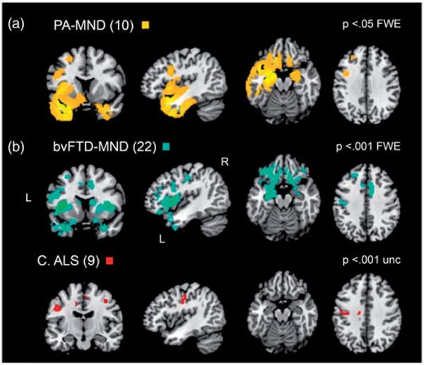 Primary progressive aphasia and the FTD-MND spectrum disorders: clinical, pathological & neuroimaging correlates. Pts w/FTD-MND can present w/language symptoms (nfvPPA & svPPA) vs exclusively bvFTD. bit.ly/3cJ8VzH @AlbaLanguage @SalvoSpinaSF @grinberg_t @Zachary94010852
