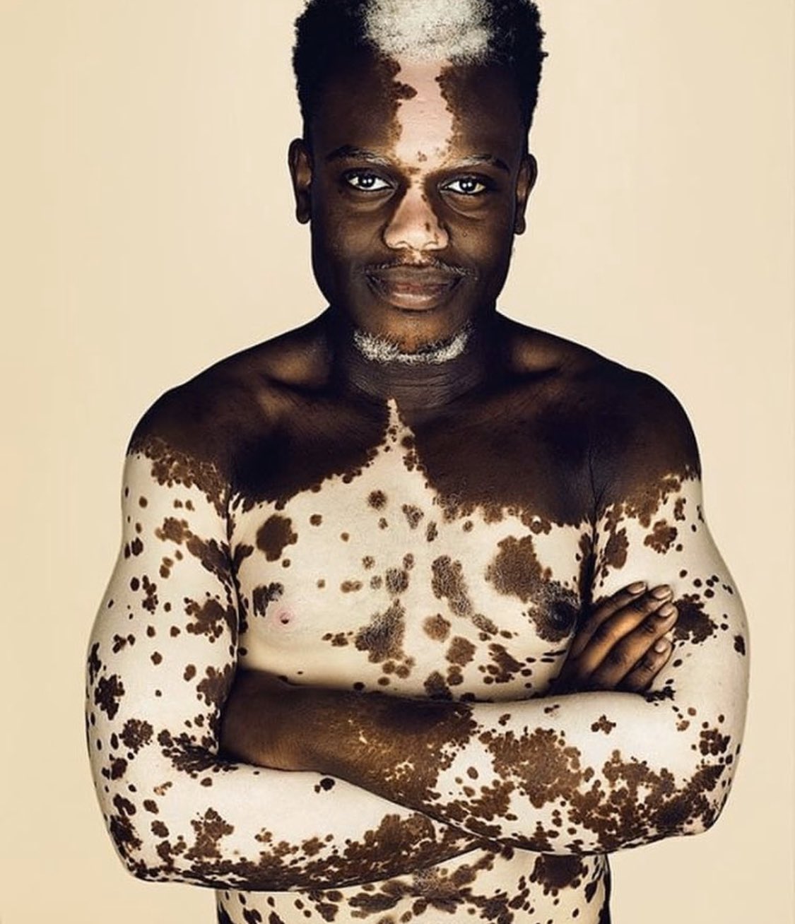 Dean Edwards I M Excited To Tell You That I Ll Be Doing My Insta Live Chat About Vitiligo Tomorrow Night Thursday 30th April At 7pm Not Only That I M Going To
