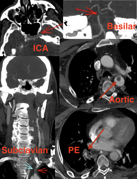 Some #stroke cases we see in young #COVID19 pts as reported in @nejm by <a href="/MountSinaiNYC/">Mount Sinai Health System</a> have unusual presentation

No doubt #SARSCoV2 ➡️high thrombophilia

Here a 54yo pt with acute Aortic, ICA, Basilar thrombi + Pulmonary embolism

⚠️Be careful to multiple territories occlusions!