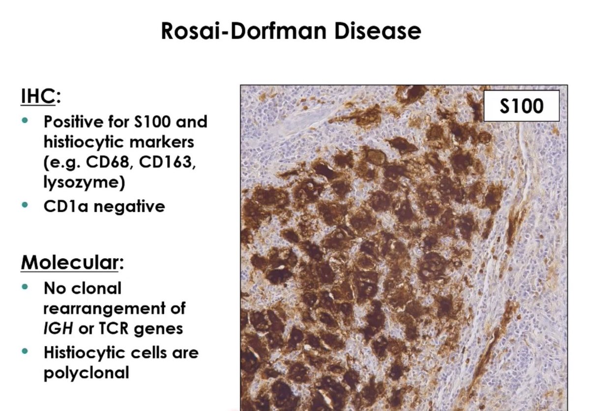 Rosai Dorfman Disease Multiple Painless Lymphadenopathy Matted Lymph