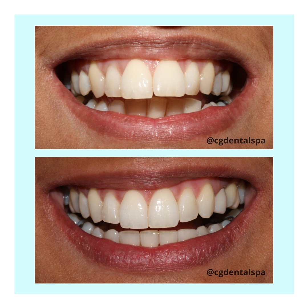 We now offer a #Virtualsmileconsultation 
✔️ We will assess your smile using photos you provide
✔️We will answer any questions you have about the Invisalign process
✔️We will offer the best solution to achieve your goals
✔️From the comfort of your sofa
✔️And it’s totally FREE!