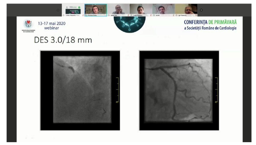 SRCCardio's tweet photo. COMPLICAŢII SAU CAZURI DIFICILE DE ANGIOPLASTIE PRIMARĂ PENTRU #STEMI ~ Moderatori Dr. Ş. Moţ, Dr.I. Nedelciuc ~ Dr.A. Bazyani, Dr.C. Mornoş,Dr.L. Predescu, Dr.O.Anchidin, Dr. R.Şerban~Conferinta de Primavara 2020 ~ https://t.co/Aoqh1enqyw ~ #CNP #GL2020 #ROCardio  
@ESCardioNews https://t.co/bC6HQwM7Rc