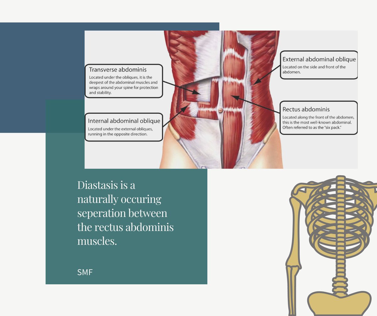 schuchardt_e's tweet photo. Did you know Diastasis is a naturally recurring separation of the linea alba and up to 100% of women will have it towards the end of the third trimester? Most 'gaps' heal on their own; some need intentional rehab. #themoreyouknow #diastasis #pregnancy https://t.co/Sc1Aw2N7Tb