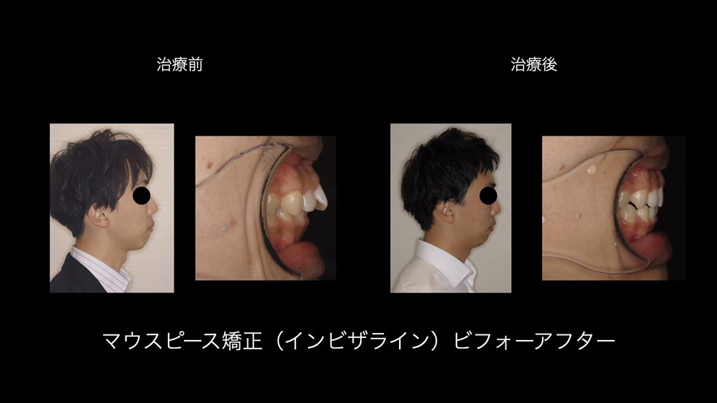 Ha Channel マウスピース矯正のビフォーアフター 横顔 マウスピース矯正経験者です ご質問あれば気軽にリプ下さい インビザライン 歯列矯正 矯正 キレイライン ビフォーアフター 治療前後 T Co Rljttaxnz2 Twitter