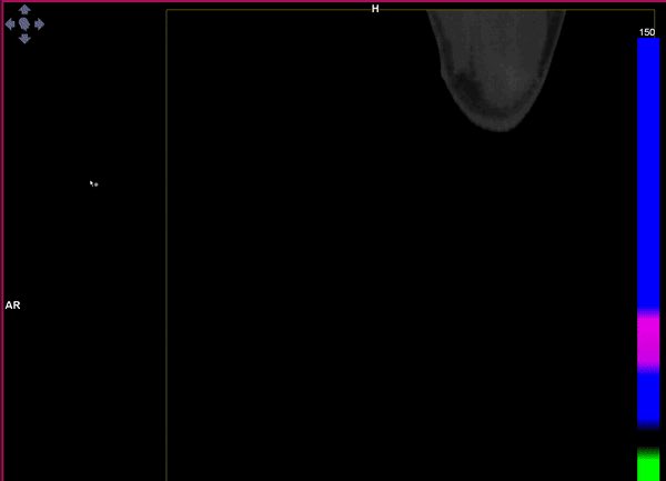Dual-Energy CT: A Diagnostic Tool for Gout with atypical presentation•A 37-year-old man presented with a 30-day history of increasing pain in both tarsometatarsal joint <a href="/ClinicaNavarra/">Clínica Universidad de Navarra</a>
