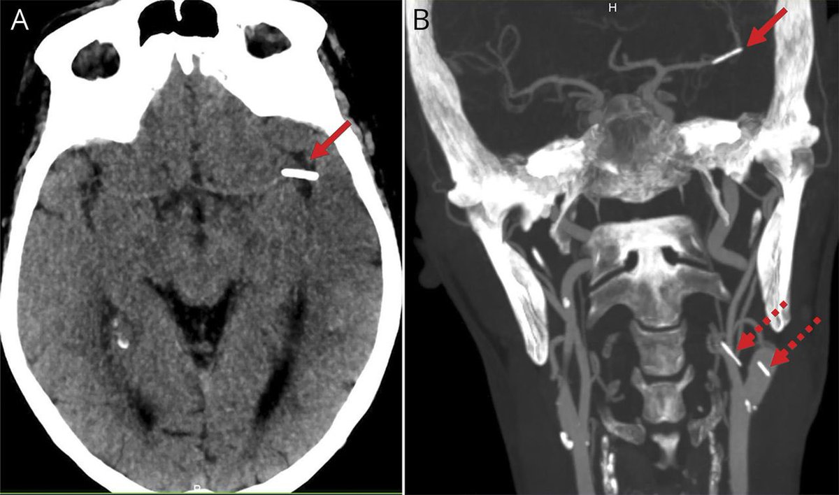 Paciente varón de 50 años adicto a drogas via parenteral y clínica aguda compatible con Ictus hemisferico izquierdo. 
En TAC craneal un signo de la arteria cerebral media híper-hiperdensa 👇