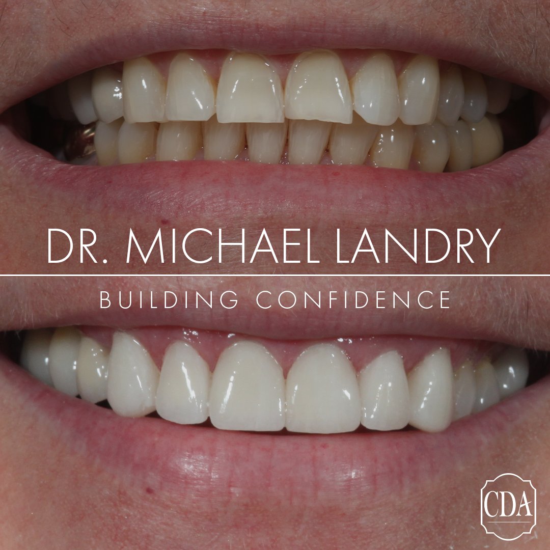 MichaelJLandryD's tweet photo. Life's stresses can show up on your face....amazing what 6 veneers can do to transform your essence.
#CDAsmile  #Veneers #VirtualSmileConsultations #BuildingConfidence https://t.co/7WoK7s9Uxu