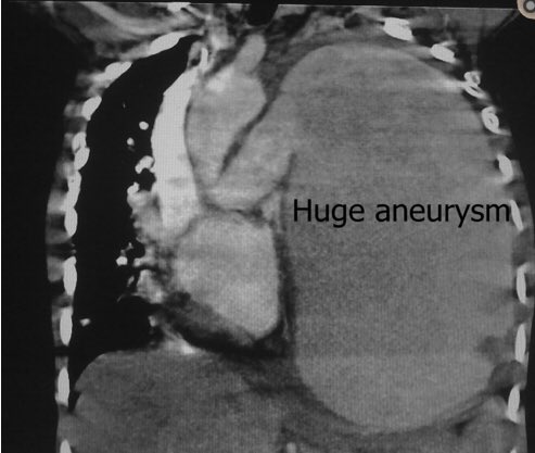 cardiopedhnn's tweet image. Este es otro caso de un enorme #aneurismaarteriapulmonar izda asociado con una PCA en una 🧒de 6 años de causa no determinada. 

👉doi.org/10.1016/j.ihj.…

Además, se adjunta artículo de revisión de Aneurismas Pulmonares. 

👉doi.org/10.1161/CIRCUL…

#echofirst #whyCCT