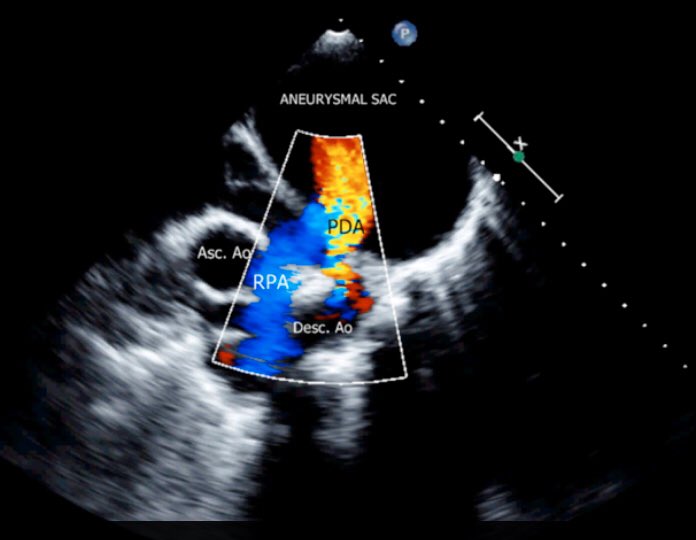 cardiopedhnn's tweet image. Este es otro caso de un enorme #aneurismaarteriapulmonar izda asociado con una PCA en una 🧒de 6 años de causa no determinada. 

👉doi.org/10.1016/j.ihj.…

Además, se adjunta artículo de revisión de Aneurismas Pulmonares. 

👉doi.org/10.1161/CIRCUL…

#echofirst #whyCCT