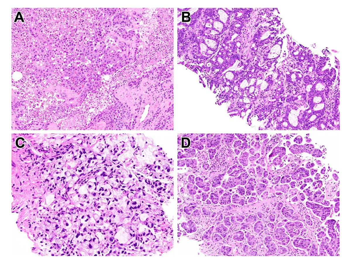 ModernPathology's tweet photo. Molecular analysis of >1,200 metastatic colorectal carcinomas reveals KRAS amplification is associated w/a history of IBD and may confer resistance to EGFR inhibitors
@PancPathologist @FavazzaLaura @ParseghianC @roysomak4 @MikeLandauMD @SiobhanIBD 
https://t.co/dFGAMNQ4W5 https://t.co/hOTQazfTp1