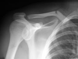 Orthopaedics MSc UCL (@orthomscucl) on Twitter photo 75-80% of clavicle fxs occur in the middle 3rd segment since the junction of the outer and middle 3rd is the thinnest part and is not protected by or reinforced with muscles and ligaments, it is therefore prone to fx particularly with axial loading
#orthotwitter #MScUCL 75-80% of clavicle fxs occur in the middle 3rd segment since the junction of the outer and middle 3rd is the thinnest part and is not protected by or reinforced with muscles and ligaments, it is therefore prone to fx particularly with axial loading
#orthotwitter #MScUCL