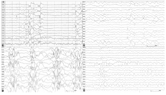 FrontierCDG's tweet image. New case report in @ElsevierConnect Journal "Brain and Development" reporting "ketogenic diet as an option for treatment of intractable epilepsy in #ALG3-#CDG."
Read: doi.org/10.1016/j.brai…