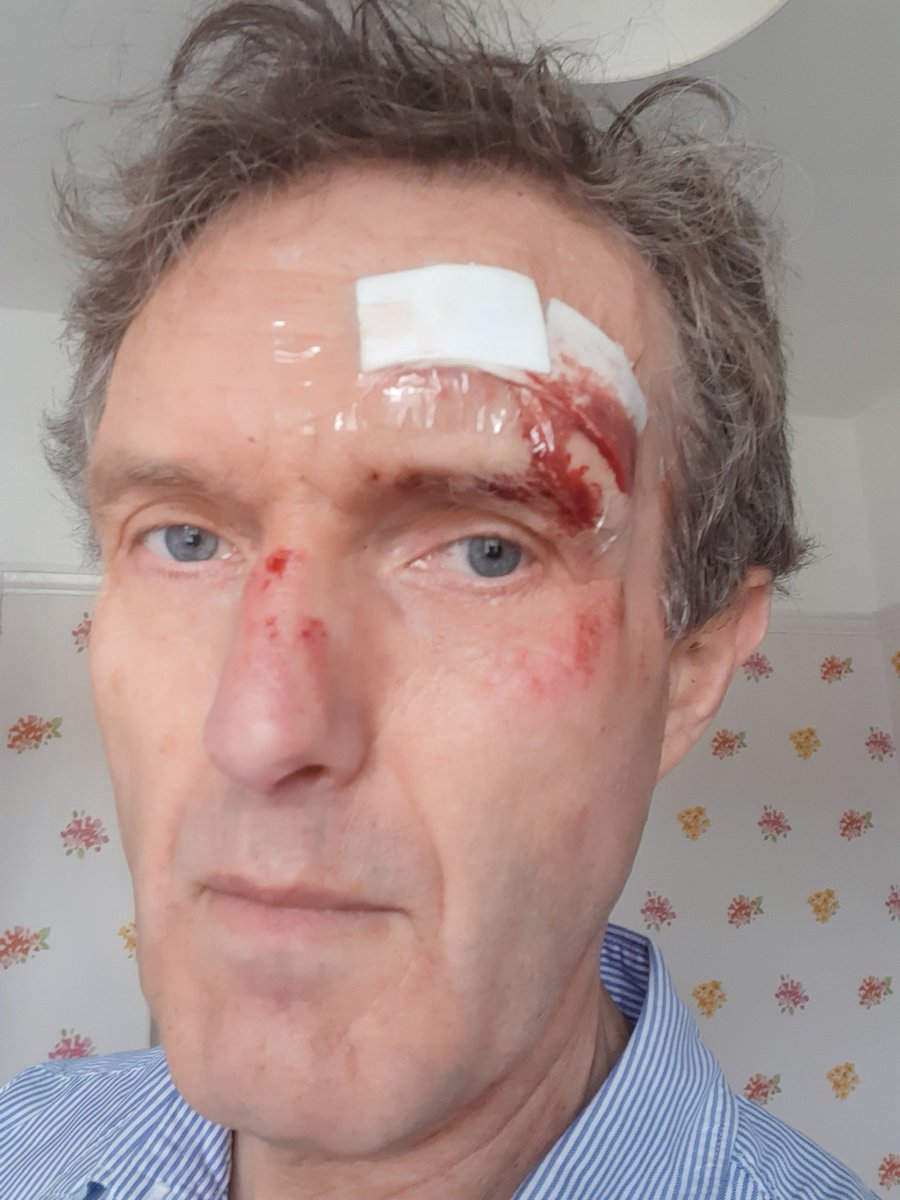 johnflathersIM's tweet photo. Thanks to all the kind nurses and other staff #northerngeneral A&amp;E in #sheffield who patched me up after a fall running this am Not COVID but I was just as pleased as anyone to have their support #supportNHS #NHSThankYou https://t.co/582SxAD1jX