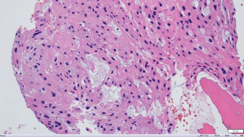ac_pathgal's tweet photo. Starting my spotter series. S1. Guess the stain/entity. Sacral mass.   #pathboards @DrSamreenfatima @PathologySayah https://t.co/gtAMGpbcns
