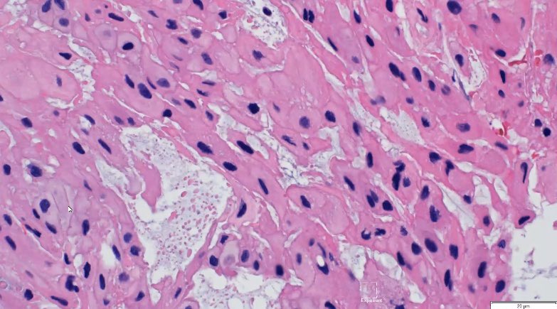 ac_pathgal's tweet photo. Starting my spotter series. S1. Guess the stain/entity. Sacral mass.   #pathboards @DrSamreenfatima @PathologySayah https://t.co/gtAMGpbcns