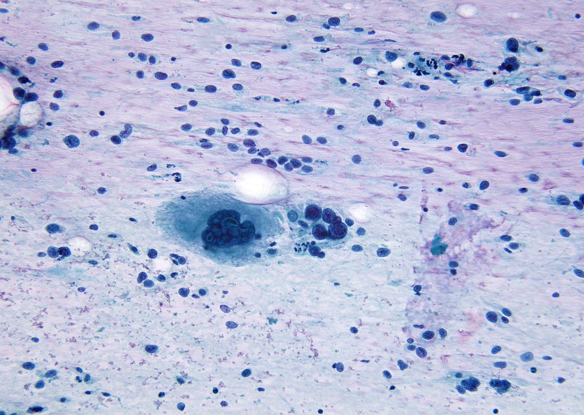 sza_jhcyto's tweet photo. Turning out to be a "Sarcoma" day - "Myxofibrosarcoma" is so eye-catching in its appearance and easy to photograph - myxoid stroma, plump spindled cells and pleomorphic MN giant cells. (thigh mass). See our old article - Acta Cytol. 2012;56(1):15-24. PMID: 22236741 https://t.co/5Ch9PzMr1L