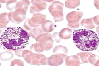 What do you see?
-One of PMN anomalies
-Called Alder–Reilly 
-Inherited abnormality of WBC 
-Asoociated with mucopolysaccharidosis
-large coarse granules in neutrophil,Monocyte and lymphocyte
-Also may be seen in Tay-sachs disease
-or in lipofuscinosis
@lab_phot #هيموتولوجي