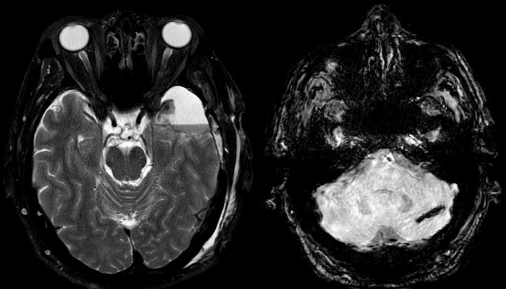 Classical history. 52-y patient. 1 day after left temporal craniotomy to resect left temporal lobe lesion.