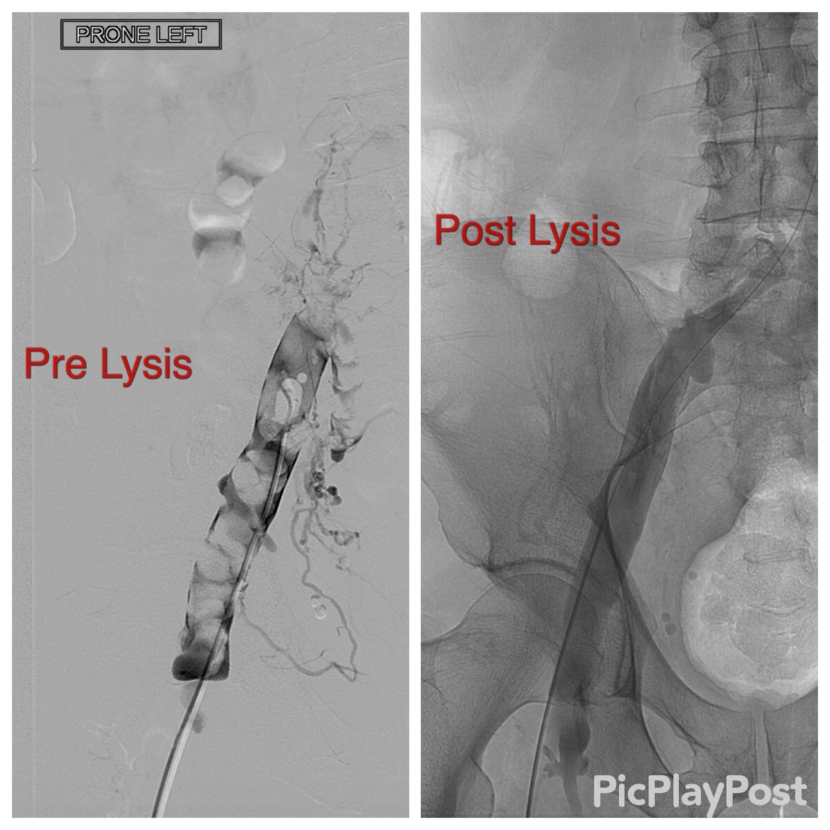 JonnyMoriarty's tweet photo. First clinical use of Bashir + for iliofemoral DVT... Great clot clearance and then venovo for May Thurner @uclaVIR #anothertool https://t.co/ngATuQ3Jvf