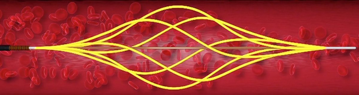 JonnyMoriarty's tweet photo. First clinical use of Bashir + for iliofemoral DVT... Great clot clearance and then venovo for May Thurner @uclaVIR #anothertool https://t.co/ngATuQ3Jvf