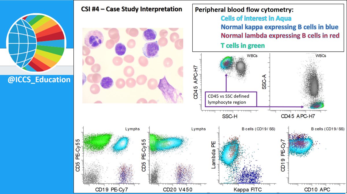 ICCS_Education's tweet photo. 60y/o man with absolute lymphocytosis (25K/uL).  #FlowCytometry is performed on PB. What is your suspected diagnosis? What additional data and/or markers would request?  Images courtesy of Dr. @sindhucherian @UWFlow @UW  Stay tuned for follow up &amp; answers! #FlowEdu #hmepath https://t.co/XcbdiXjwqI