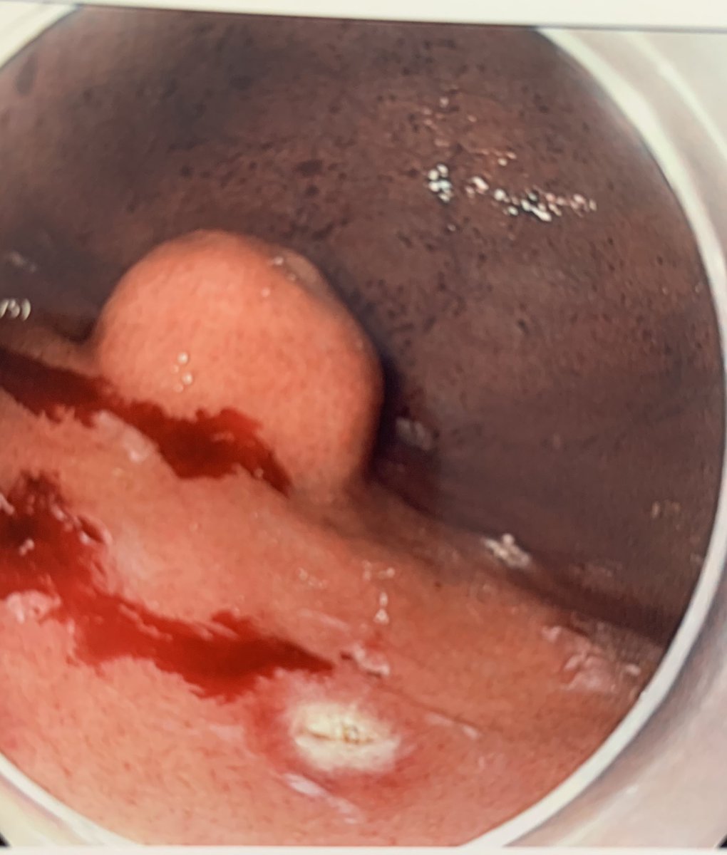 IAndalib's tweet photo. As we start to ramp up our endoscopic activities, today we performed an endoscopic full-thickness resection of a 2.5cm GIST in the fundus. #surgicalendoscopy #Mountsinai #thirdspaceendoscopy https://t.co/1giGl4hXaX