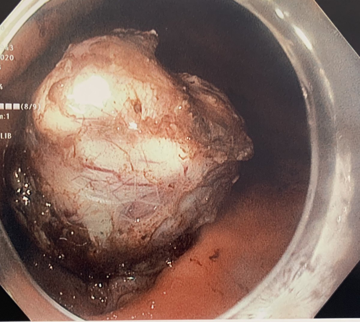 IAndalib's tweet photo. As we start to ramp up our endoscopic activities, today we performed an endoscopic full-thickness resection of a 2.5cm GIST in the fundus. #surgicalendoscopy #Mountsinai #thirdspaceendoscopy https://t.co/1giGl4hXaX