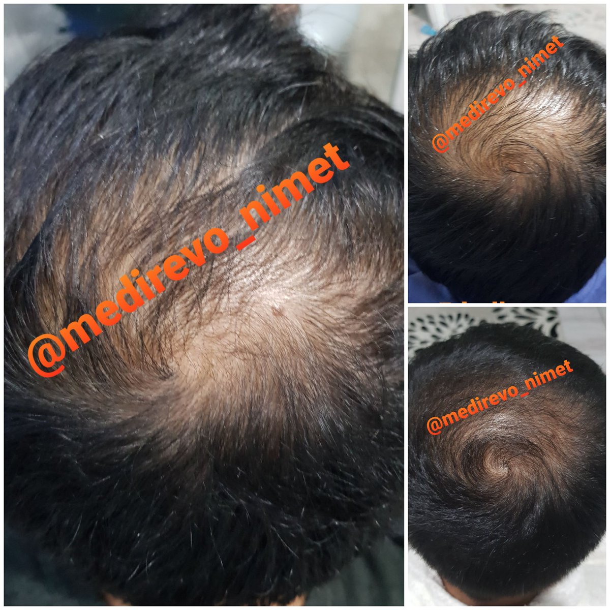 saclarinizin dokulmesine son vermek yeni saclarinizin cikmasini saglamak medirevo urunleri ile mumkun...kesinlikle hicbir yan etkisi yoktur...