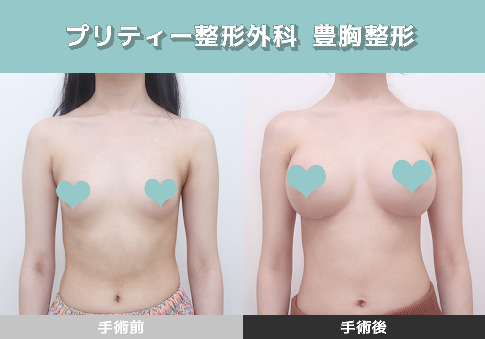Uzivatel プリティー整形外科 Na Twitteru 豊胸整形 メンターで手術を受けた方の症例写真です 外側まで豊かで正面からもボリュームパッチリ 外側が豊かであるこそ下着を着た時きれいな谷間ができます ファロー歓迎 お問い合わせは ライン Preetyps まで