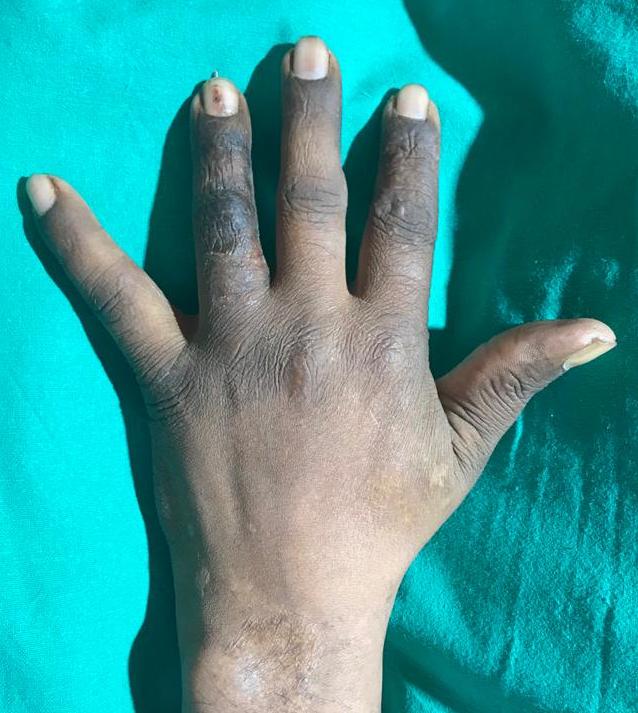 aiims_rpr's tweet photo. एम्स के अस्थि रोग विभागाध्यक्ष प्रो. आलोक चंद्र अग्रवाल के निर्देशन में एक जटिल ऑपरेशन कर एक श्रमिक के हाथ की क्षतिग्रस्त अंगुली को न सिर्फ ठीक किया गया बल्कि पैर की अंगुली से उसके हाथ की अंगुली के ज्वाइंट को प्राकृतिक रूप से बनाया गया। 
#AIIMS
#harkaamdeshkenaam https://t.co/PFXhEO7np2