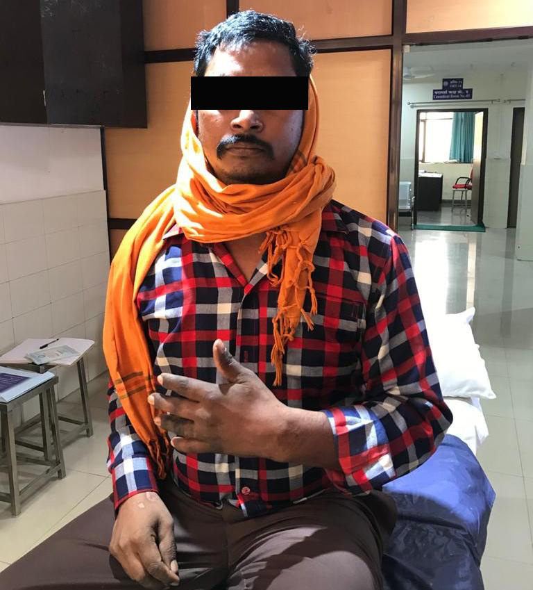 aiims_rpr's tweet photo. एम्स के अस्थि रोग विभागाध्यक्ष प्रो. आलोक चंद्र अग्रवाल के निर्देशन में एक जटिल ऑपरेशन कर एक श्रमिक के हाथ की क्षतिग्रस्त अंगुली को न सिर्फ ठीक किया गया बल्कि पैर की अंगुली से उसके हाथ की अंगुली के ज्वाइंट को प्राकृतिक रूप से बनाया गया। 
#AIIMS
#harkaamdeshkenaam https://t.co/PFXhEO7np2