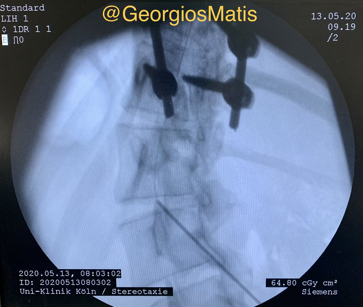 GeorgiosMatis's tweet photo. 🔹Patient with multifocal #chronicpain syndrome
🔹#Scoliosis
🔹#Instrumentation T1-T11, multiple rib resections & #detethering of #tetheredcord (L4-L5)
🔹Implantation of an #intrathecal catheter for a #morphine trial
#neuromodulation #IDDS #ziconotide #neurosurgery @VVV_Cologne https://t.co/EJbnKxoRbQ