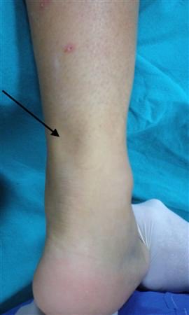 Orthopaedics MSc UCL (@orthomscucl) on Twitter photo Achilles tendon is the largest tendon in the body formed by the confluence of the soleus muscle tendon and medial and lateral gastrocnemius tendons. 
Blood supply is from the posterior tibial artery
Acute rupture may be missed in up to 25% of the cases
#orthotwitter #MScUCL Achilles tendon is the largest tendon in the body formed by the confluence of the soleus muscle tendon and medial and lateral gastrocnemius tendons. 
Blood supply is from the posterior tibial artery
Acute rupture may be missed in up to 25% of the cases
#orthotwitter #MScUCL