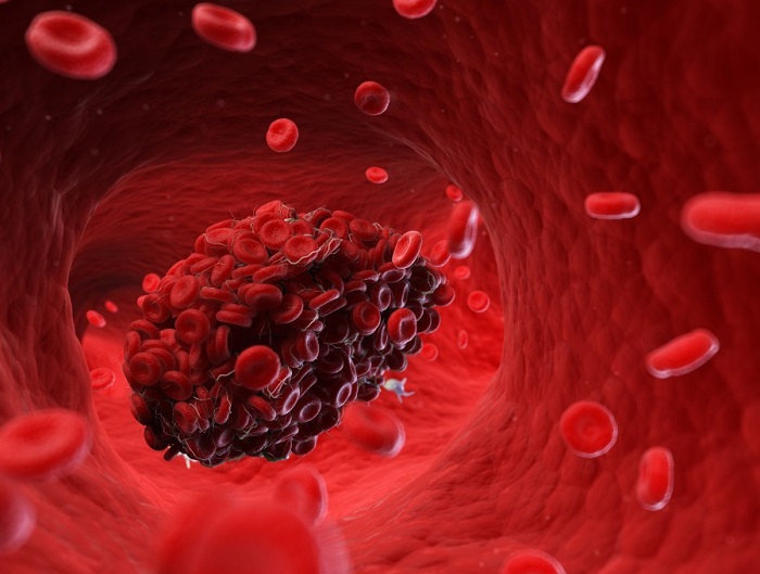 Chronicmeet's tweet photo. Using cutting-edge technology, a new tool was developed that was able to distinguish different types of blood clots based on what caused them - https://t.co/xmRa83APis

#chronicillness #hematology #Blood #COVID19 #research https://t.co/kFVjm3LlNt