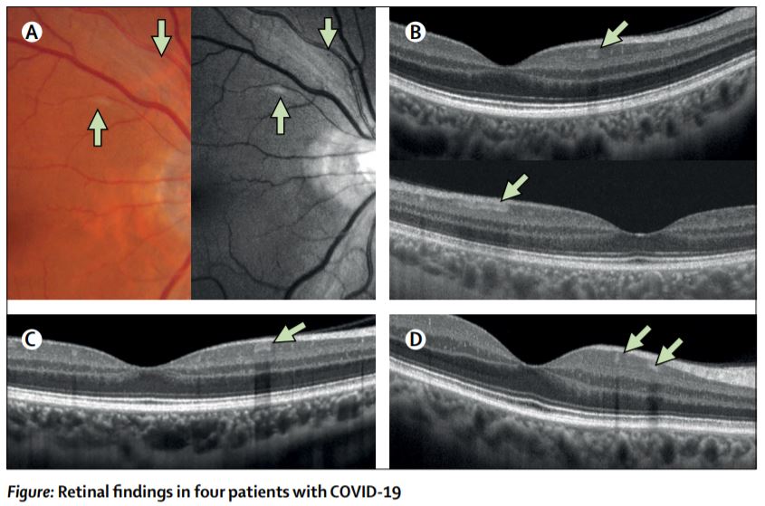 TheLancet's tweet photo. NEW Correspondence—Retinal findings in patients with #COVID19

Paula M Marinho et al report retinal and optical coherence tomography changes in 12 adults (six men and six women, aged 25–69 years), examined 11–33 days after COVID-19 symptom onset https://t.co/ffRF3s43Wo https://t.co/ssyXHaytQ8