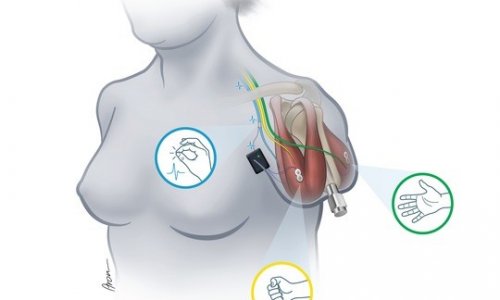 EuropHospital_D's tweet image. #Bionik: Forscher von @MedUni_Wien, @MIT und @goteborgsuni haben die weltweit erste voll integrierte bionische #Prothese entwickelt, die nach dem Motto „Plug and Play“ einsetzbar ist. #smartprosthetics healthcare-in-europe.com/de/news/bionis…