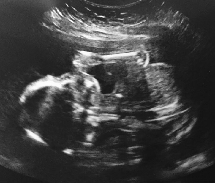 NICHE_ULSTER's tweet photo. Today we would like to showcase our #NICHEBvits research on #FolicAcid supplementation in #pregnancy. Results from the #FASSTT Offspring Trial #Cognition #DNAMethylation 
 
https://t.co/it0deI6G7x
https://t.co/r37AyLPprQ
https://t.co/y9hX8qC8uD
https://t.co/KOjoNxIH5Z https://t.co/qFl9n3QH12