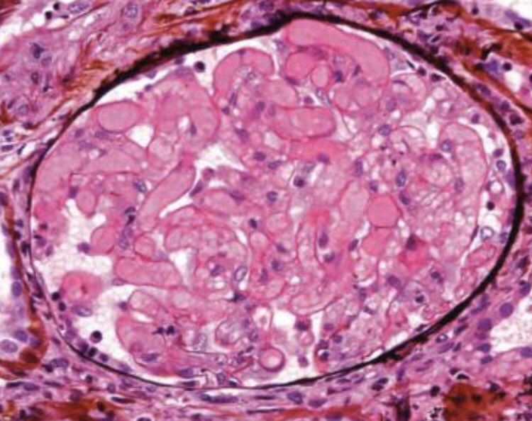 💢What is glomerular paralysis❓

⚡️TMA with severe vascular lesion 👉Distended glomeruli with severe congestion
🔆Classically in TMA with thrombus in Afferent art or terminal interlobular art upstream of involved glomerulus

Pic-Silva's Pathology
#NephroNotes #NephPearls #FOAMed