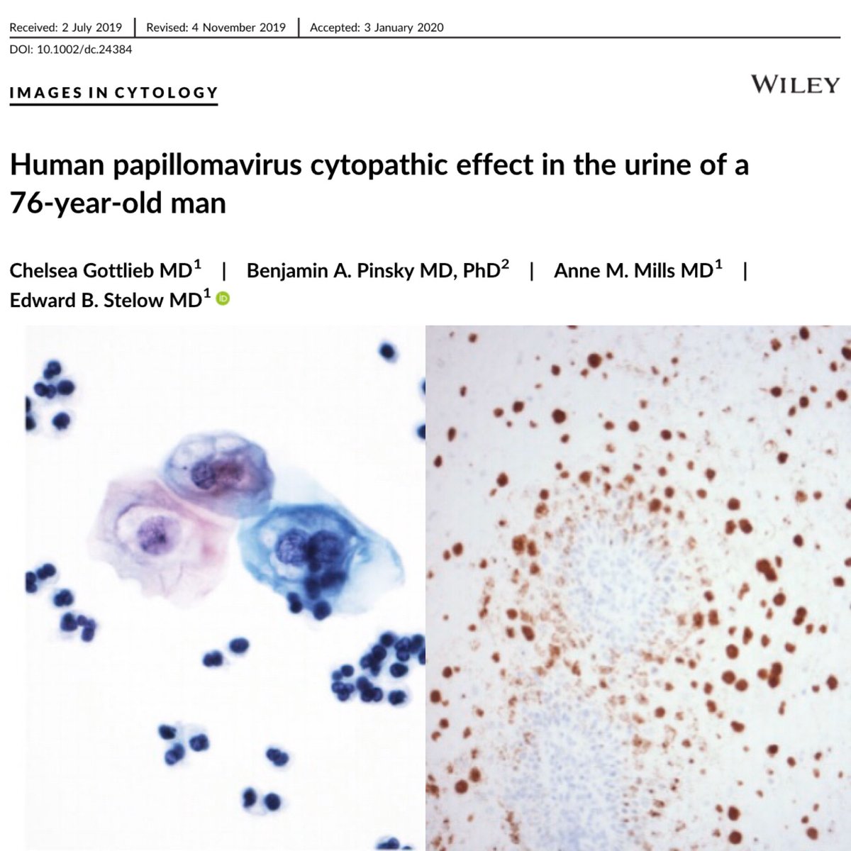 human papillomavirus cytopathic effect)