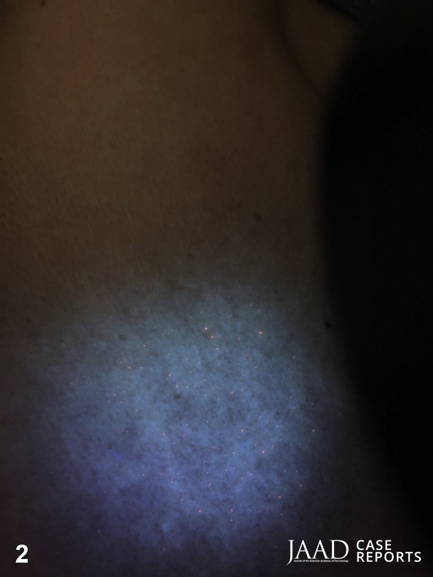 JAADjournals's tweet photo. A mysterious white rash in a 40-year-old Vietnamese man. What's the diagnosis?

A. Pityriasis alba
B. Pityriasis (tinea) versicolor
C. Postinflammatory hypopigmentation
D. Progressive macular hypomelanosis
E. Vitiligo

Answer: https://t.co/21t4Dynvo0 https://t.co/zD1aewOMUx