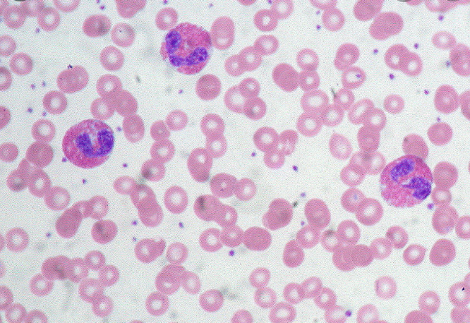 Eosinophils matter:Inspired by yesterday’s  @CPSolvers case + last week’s NEJM case, reprising this thread with 5 more real case examples of this take-home point: In acute presentations, eosinophilia is often a pivot point: it dramatically shifts/narrows the ddx.1/11