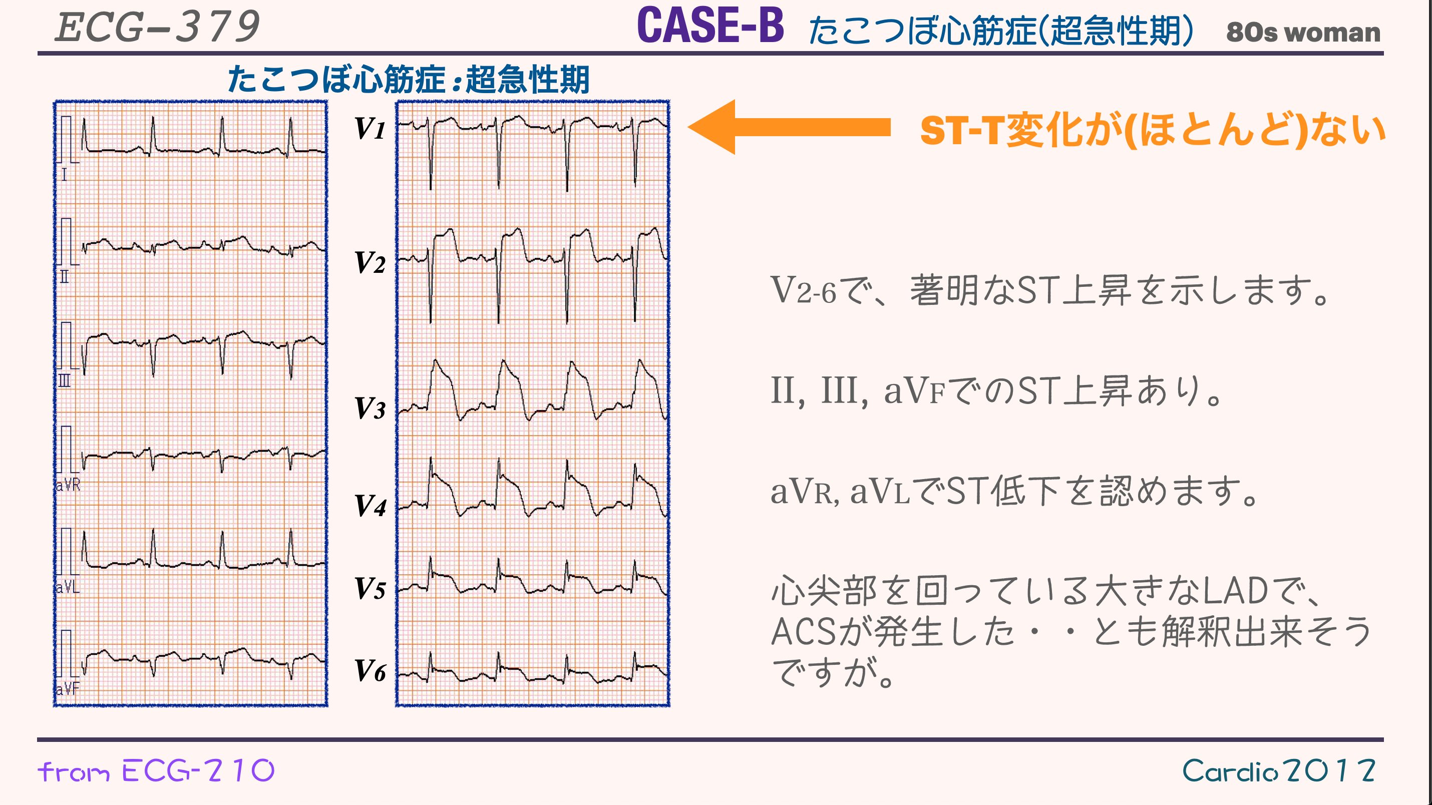 N. Tsukishima EP大学心電図検定学部試験対策科担任 on X N. Tsukishima EP大学心電図検定学部試験対策科担任 on X