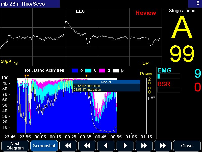 So, with that in mind, what does a TST RSI look like? (with a bit of Alf - I’m a big boy now…). This is reflects experience so far. This this the awake EEG. Lovely fine, low amplitude B-waves. Correctly classified Stage A whilst preoxygenatingDon't look at the rest yet…