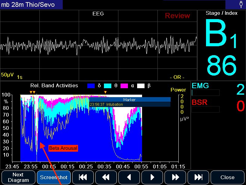 Straight forward Glidescope DVM intubation - no strong left arm needed! ETCO2  and onto Sevo (start at 8%). Look at the Beta - arousal! EEG now showing loss of delta activity, and increased beta. This is sedation - not anaesthesia! Seen this several times with STP... why?